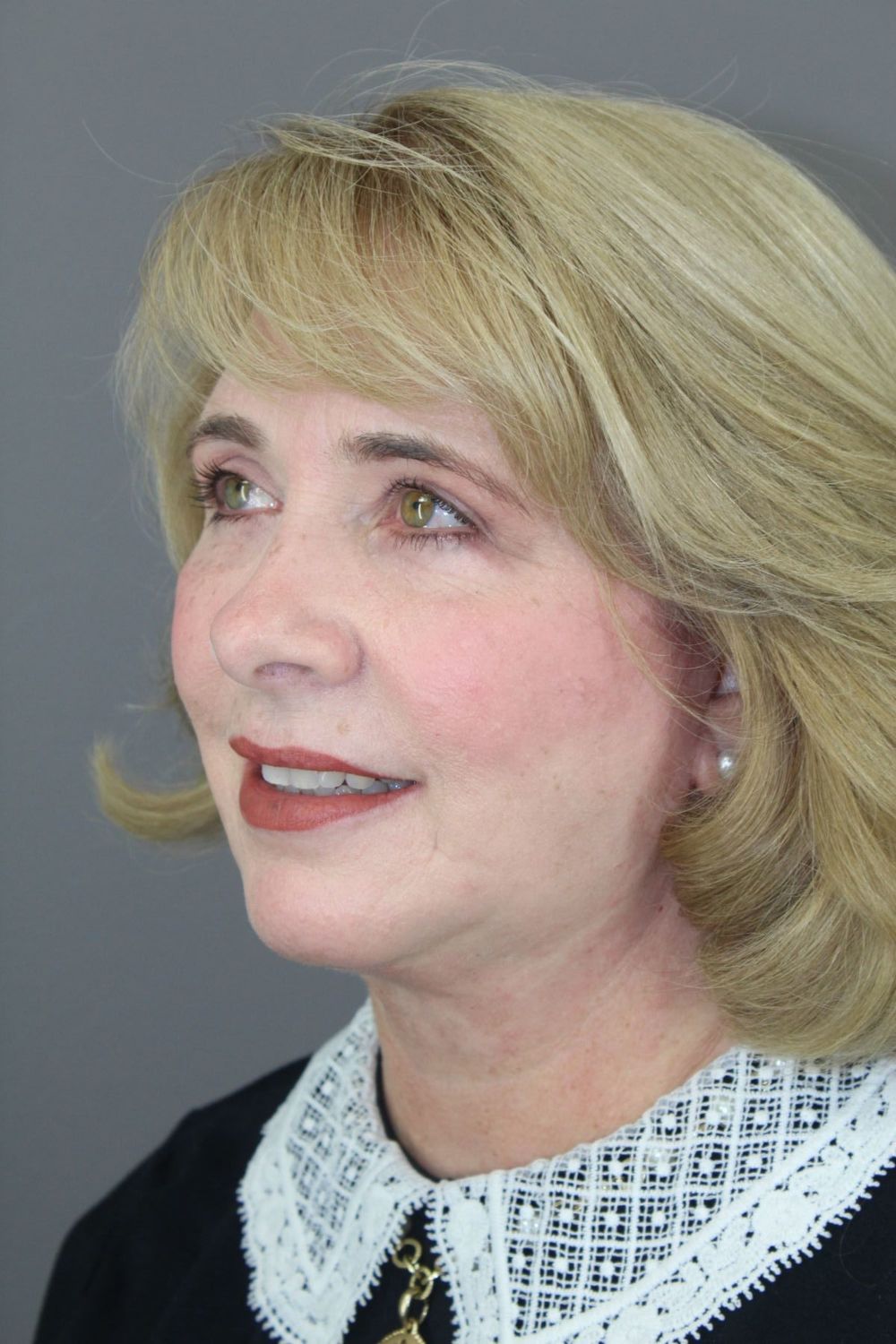 Chin Augmentation Before & After