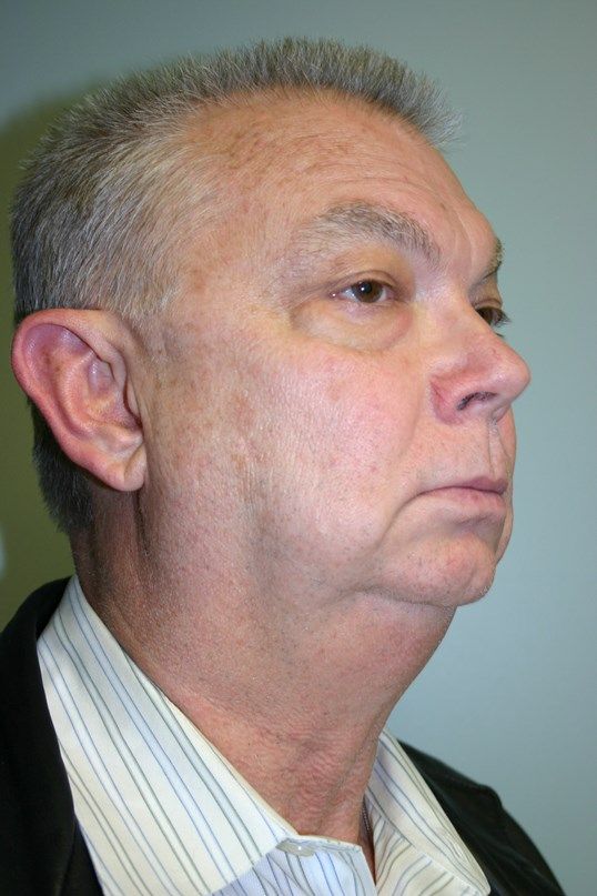 Chin Augmentation Before & After