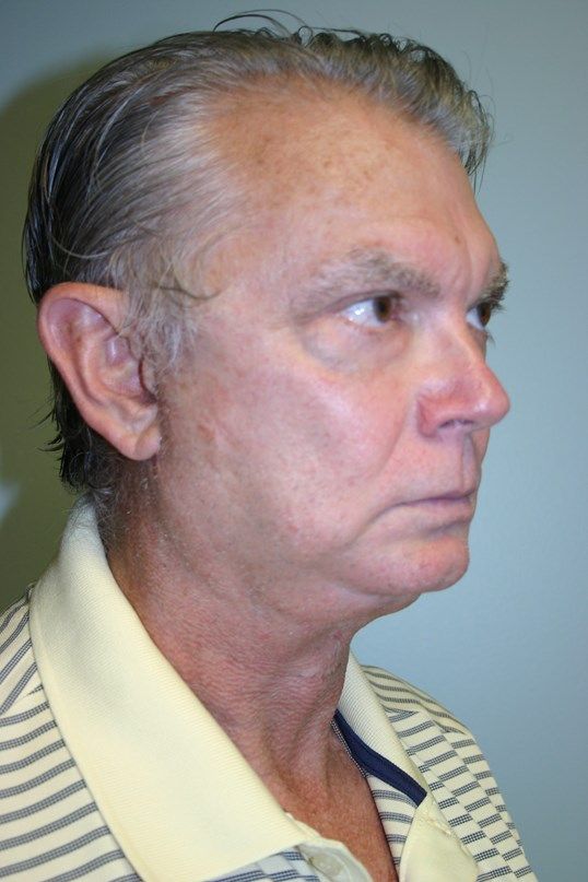 Chin Augmentation Before & After