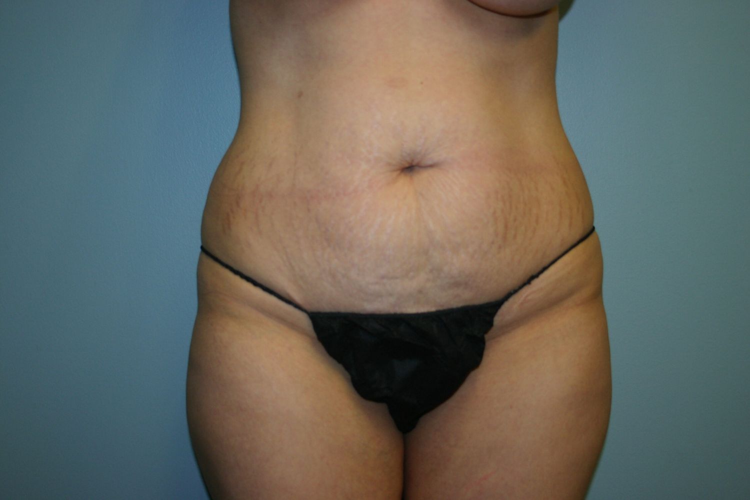 Fat Transfer Before & After