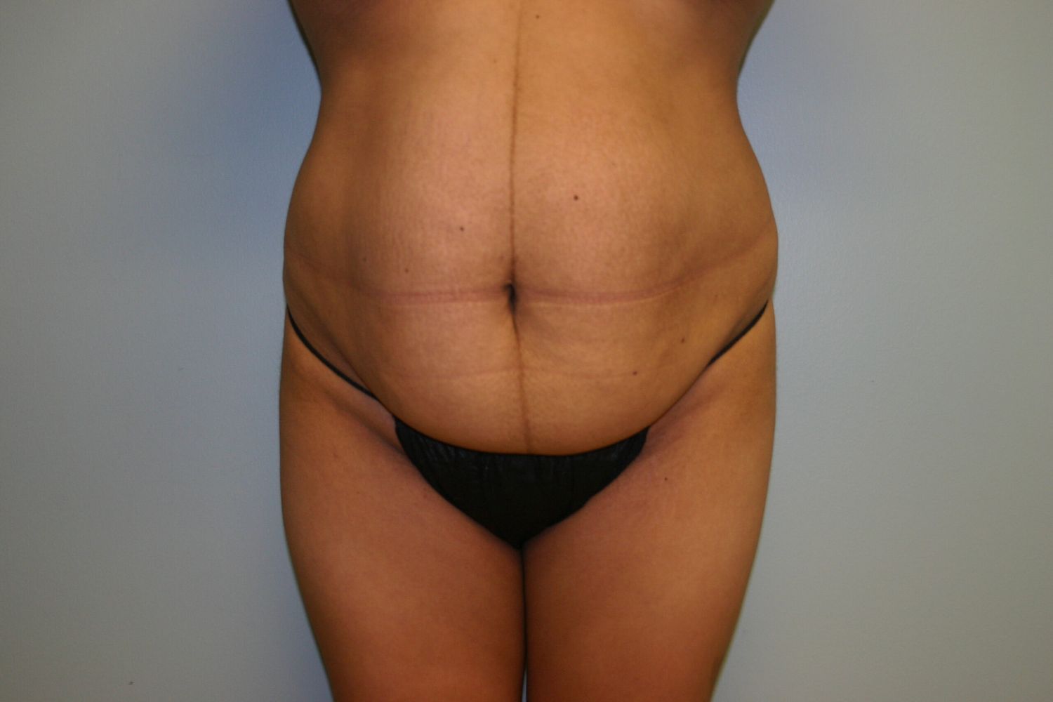 Fat Transfer Before & After