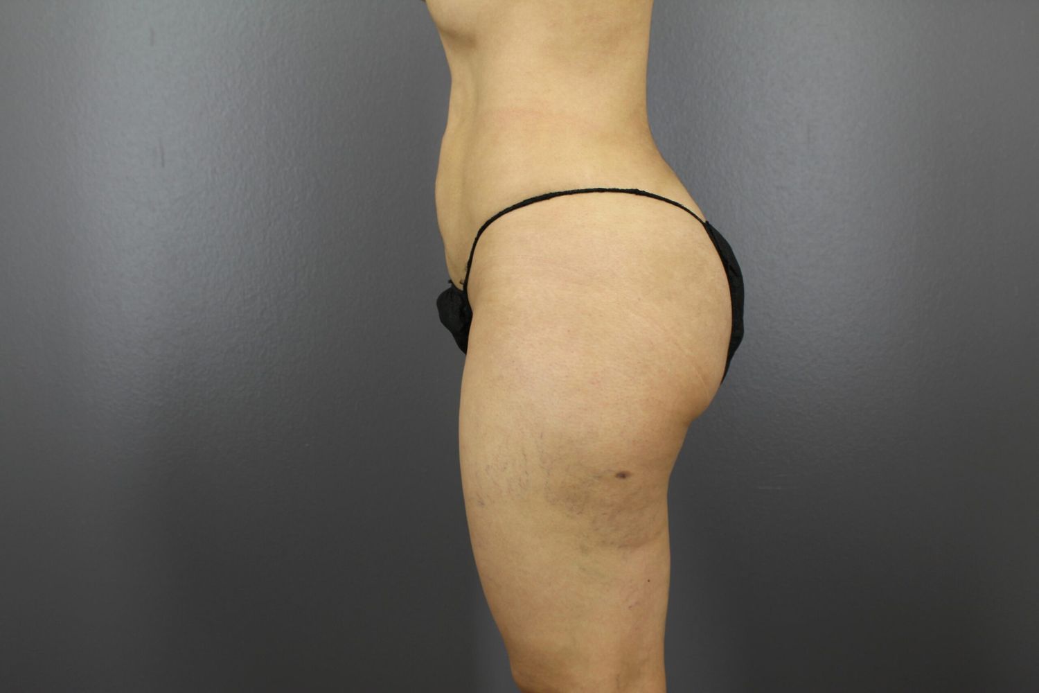 Fat Transfer Before & After