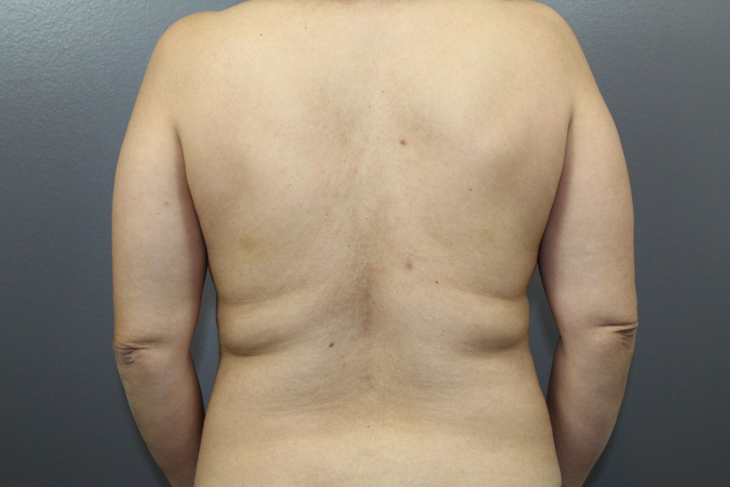 Fat Transfer Before & After