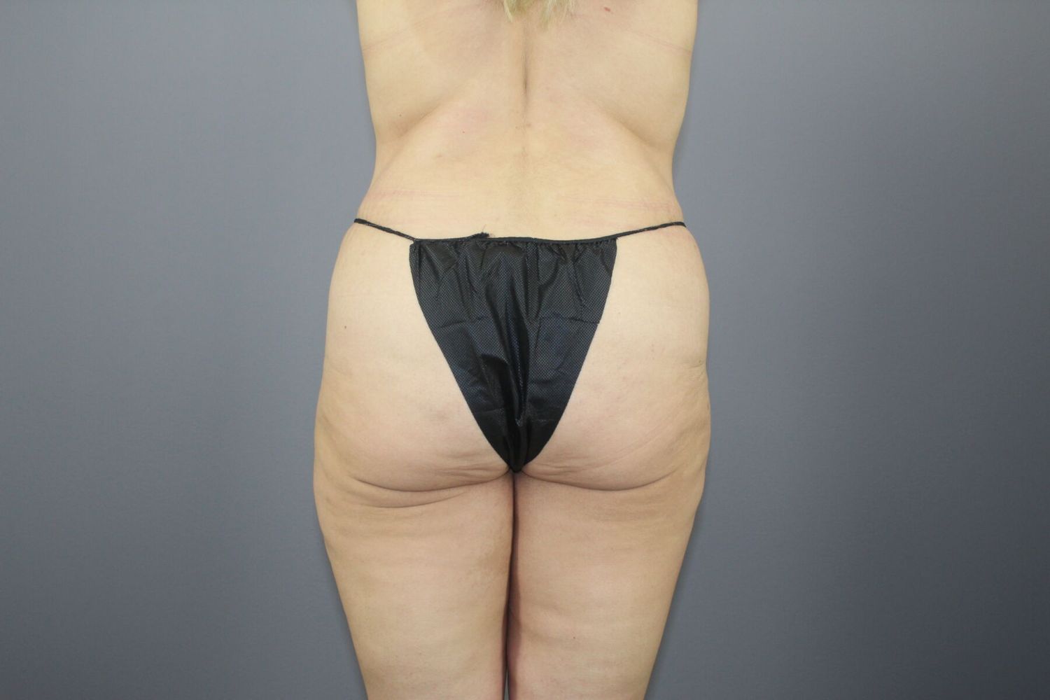 Fat Transfer Before & After