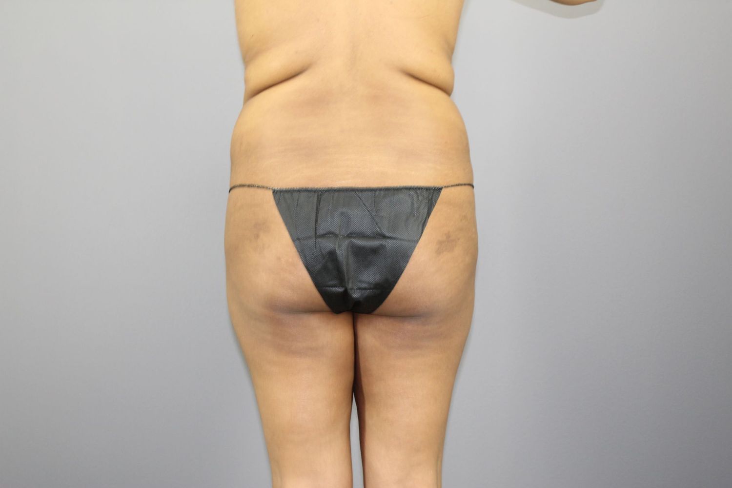 Fat Transfer Before & After