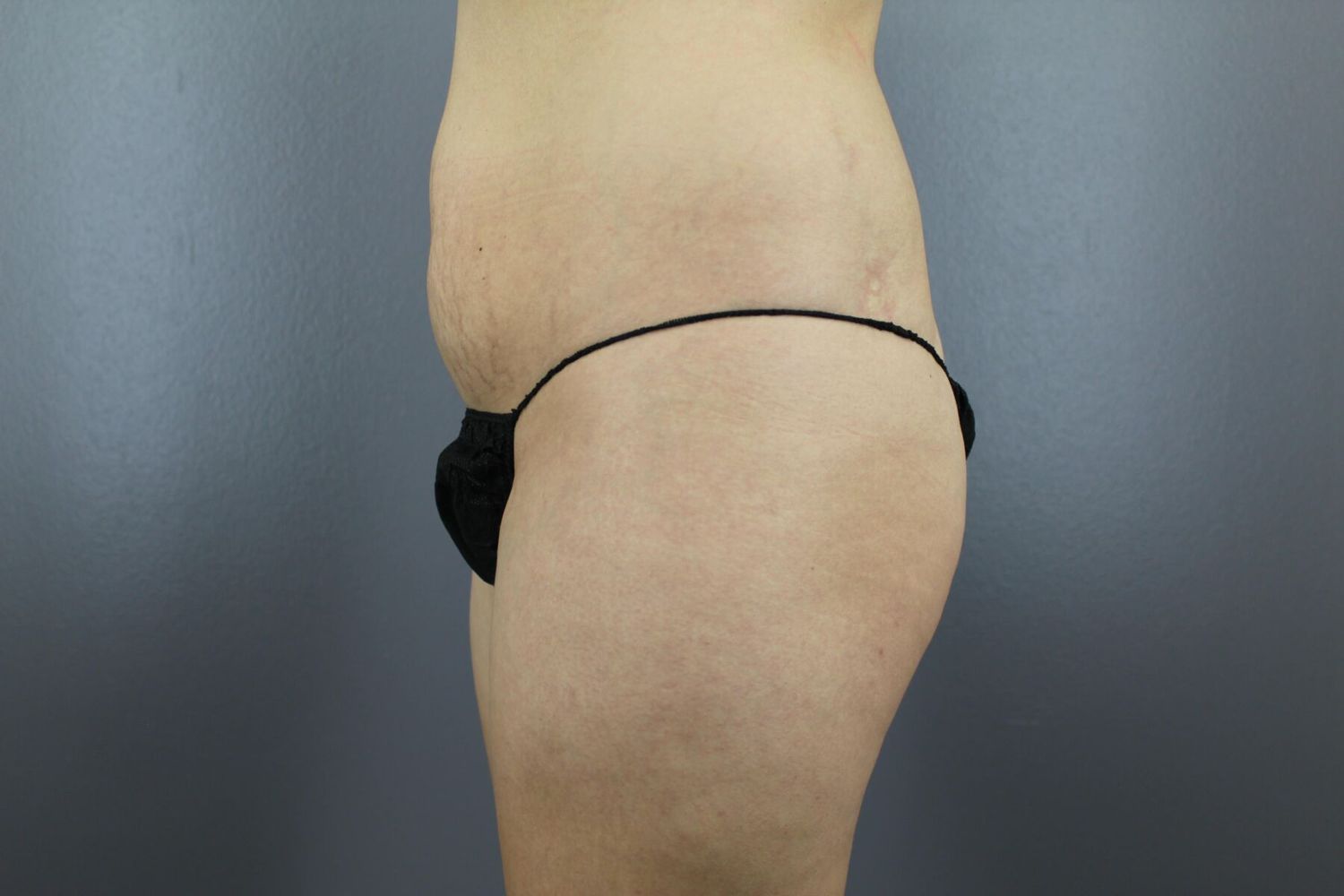 Fat Transfer Before & After