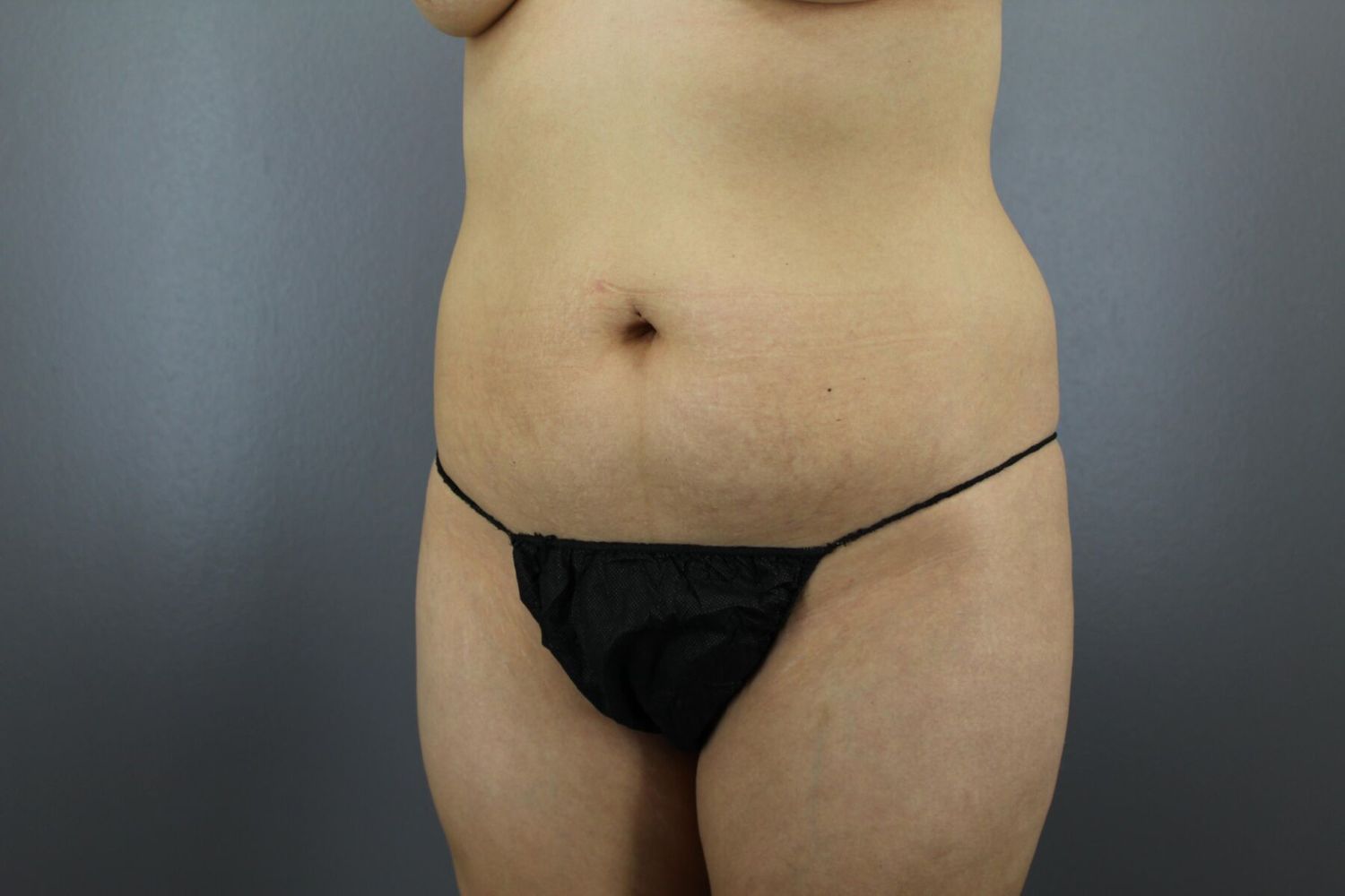 Fat Transfer Before & After