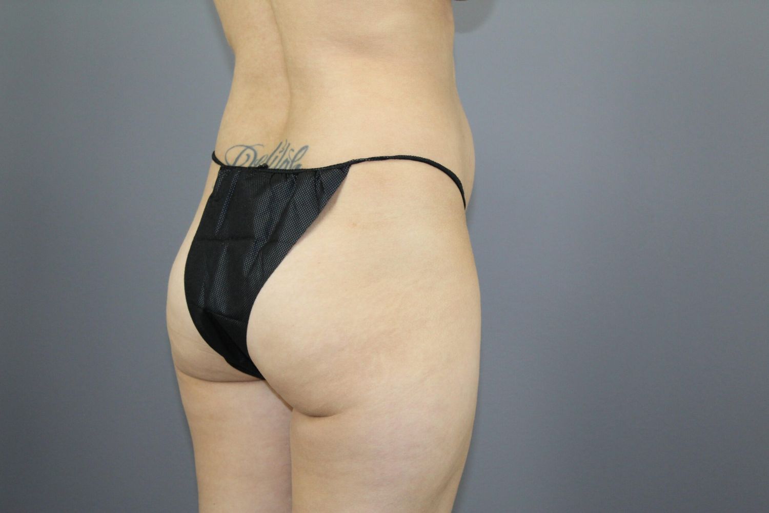 Fat Transfer Before & After