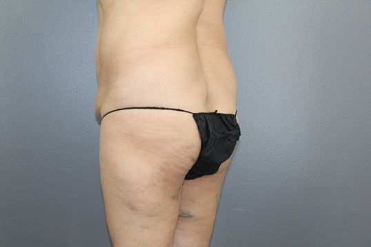 Fat Transfer Before & After