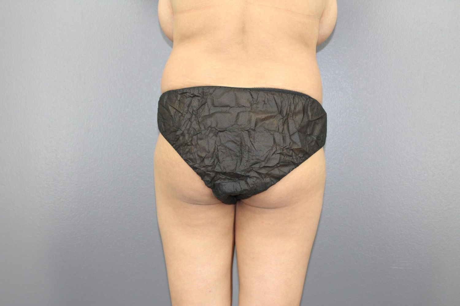 Fat Transfer Before & After