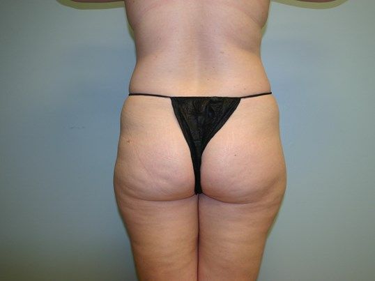 Fat Transfer Before & After