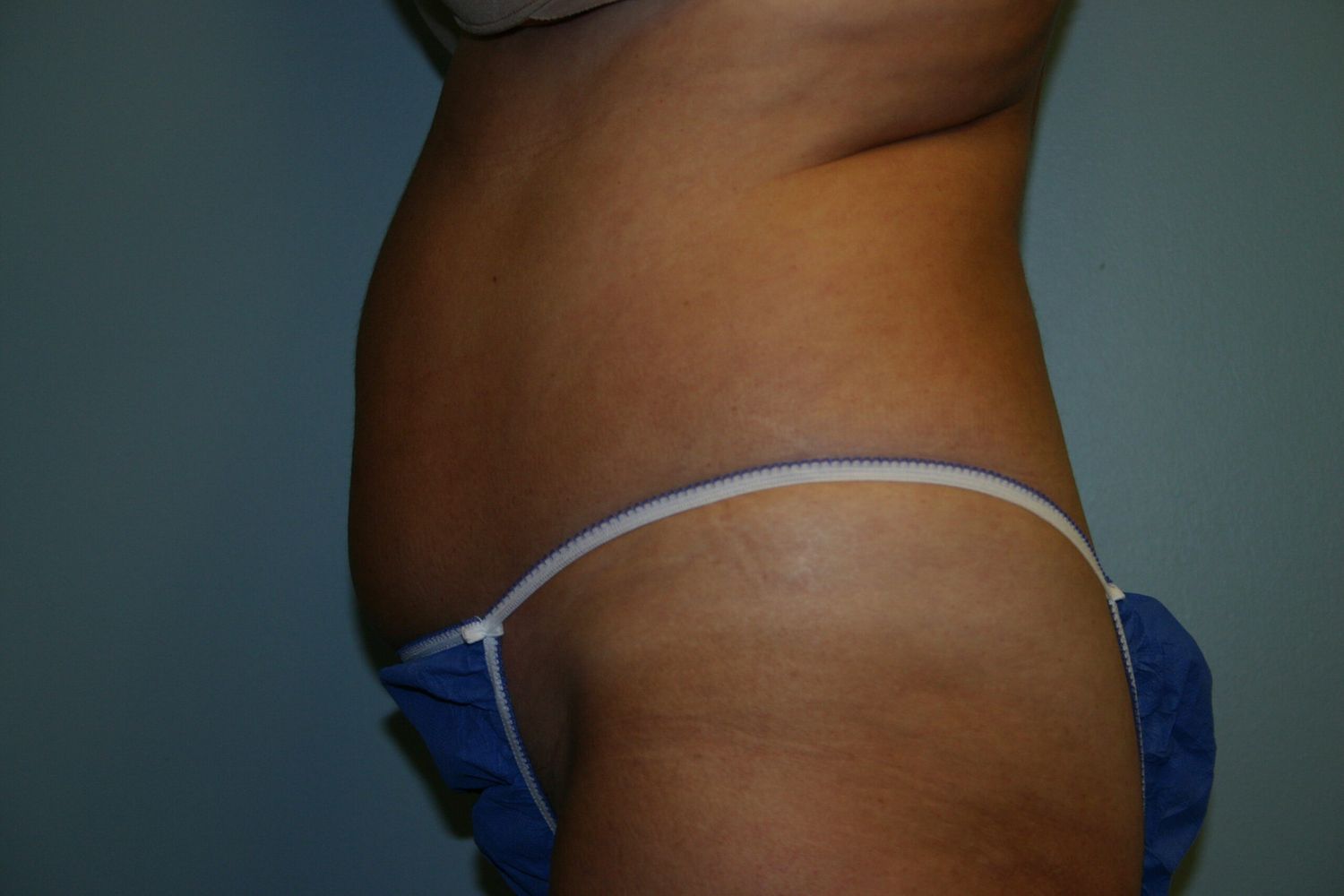 Fat Transfer Before & After