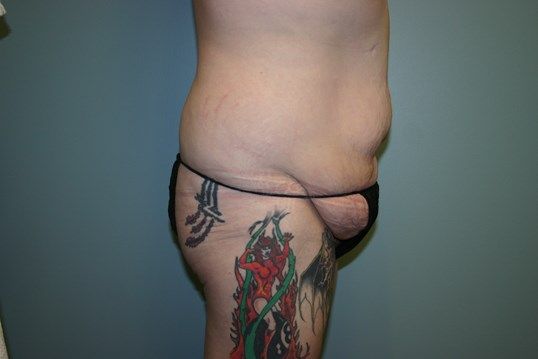 Fat Transfer Before & After