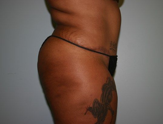 Fat Transfer Before & After