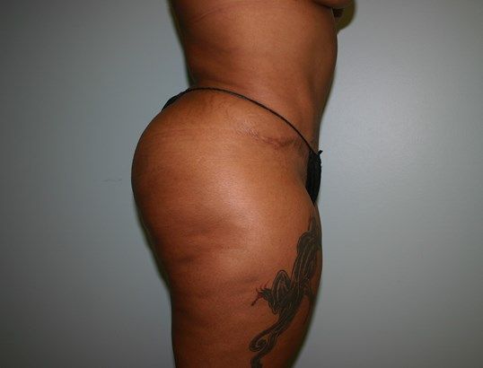 Fat Transfer Before & After