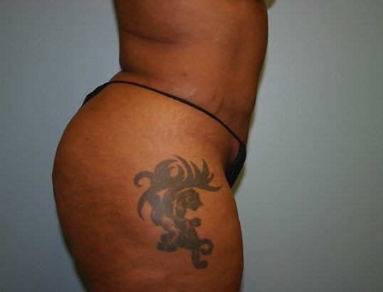 Fat Transfer Before & After