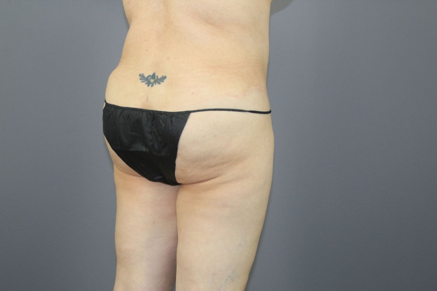 Fat Transfer Before & After