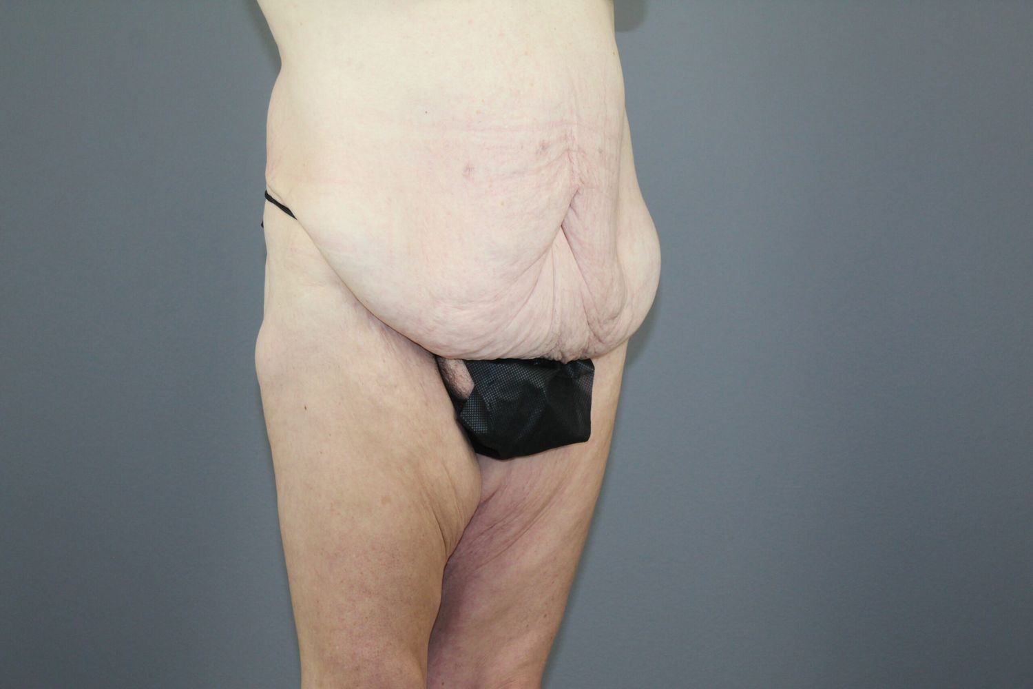 Lower Body Lift Before & After