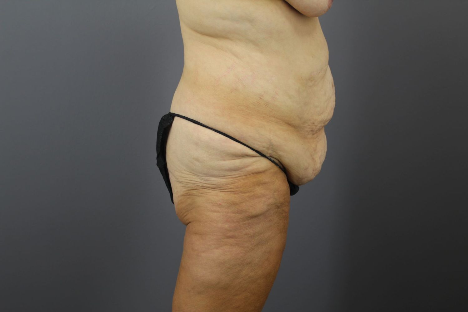 Lower Body Lift Before & After