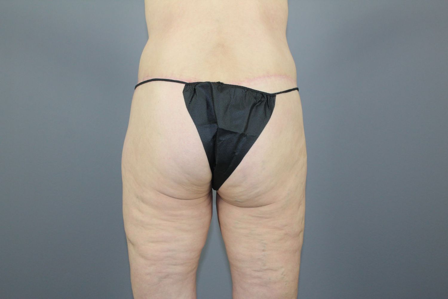 Lower Body Lift Before & After