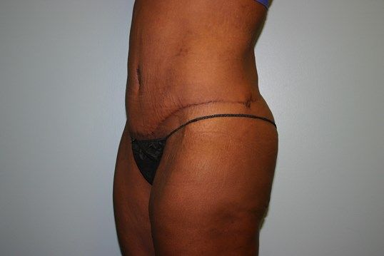 Lower Body Lift Before & After