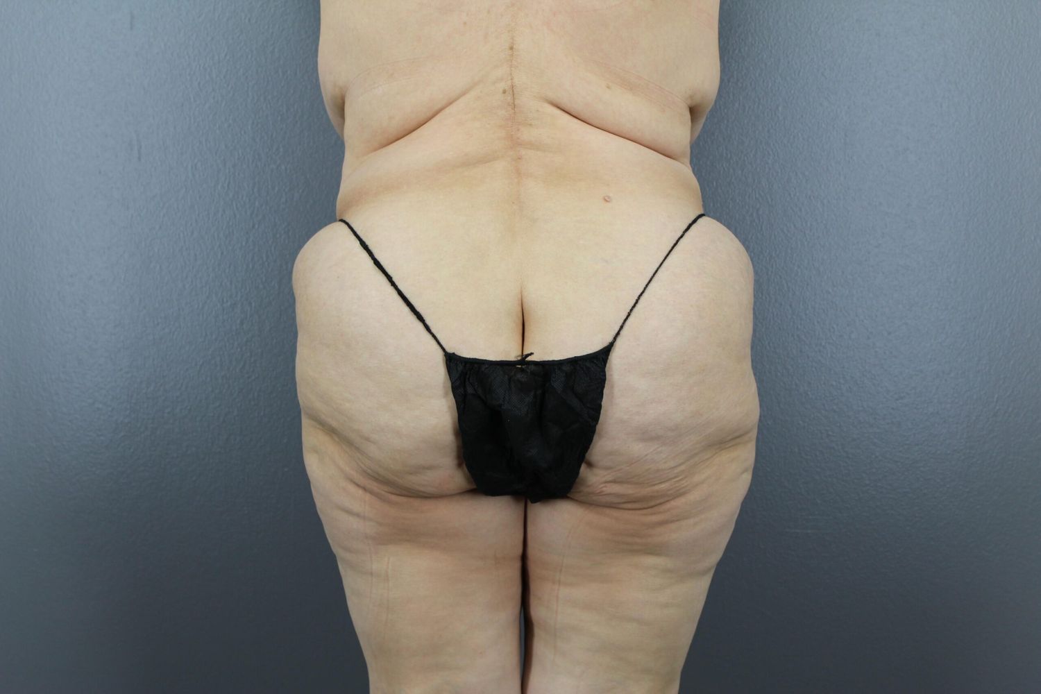 Lower Body Lift Before & After