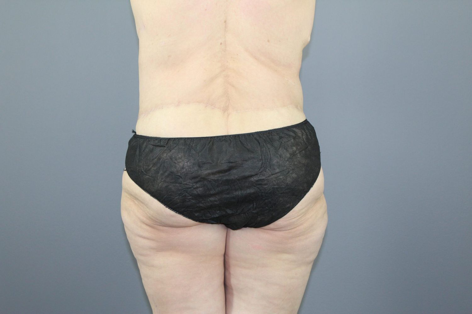 Lower Body Lift Before & After