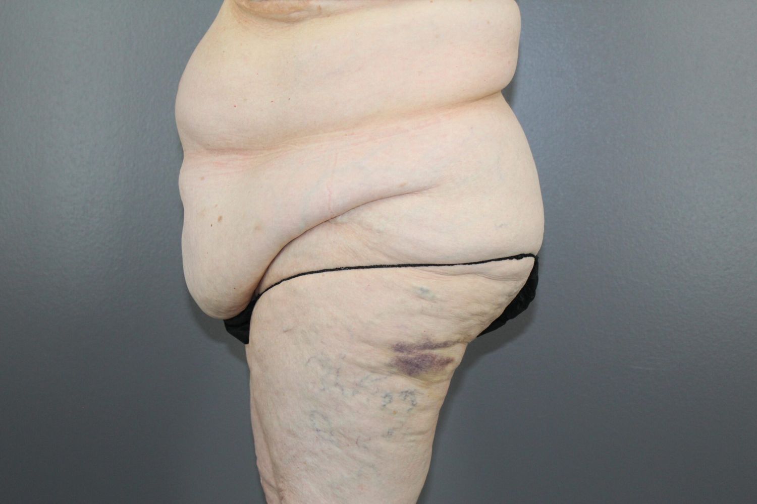 Lower Body Lift Before & After