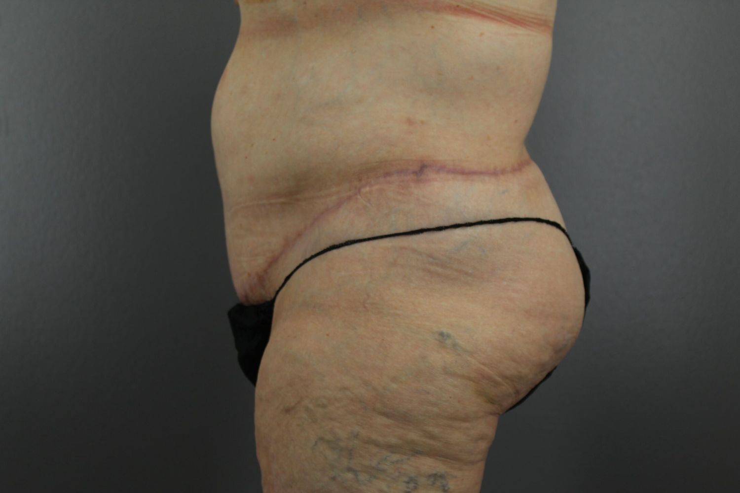 Lower Body Lift Before & After