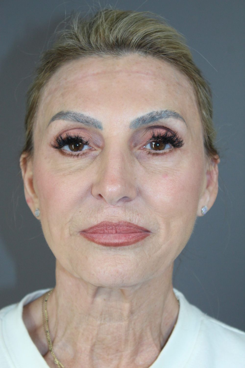 Facial Peels Before & After