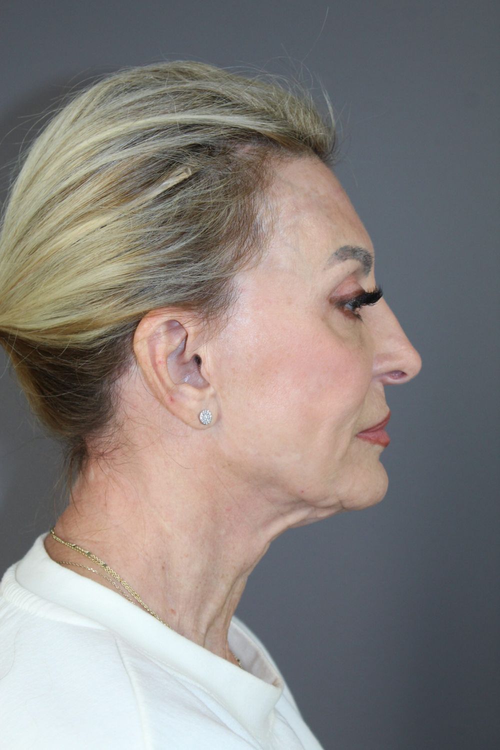 Facial Peels Before & After