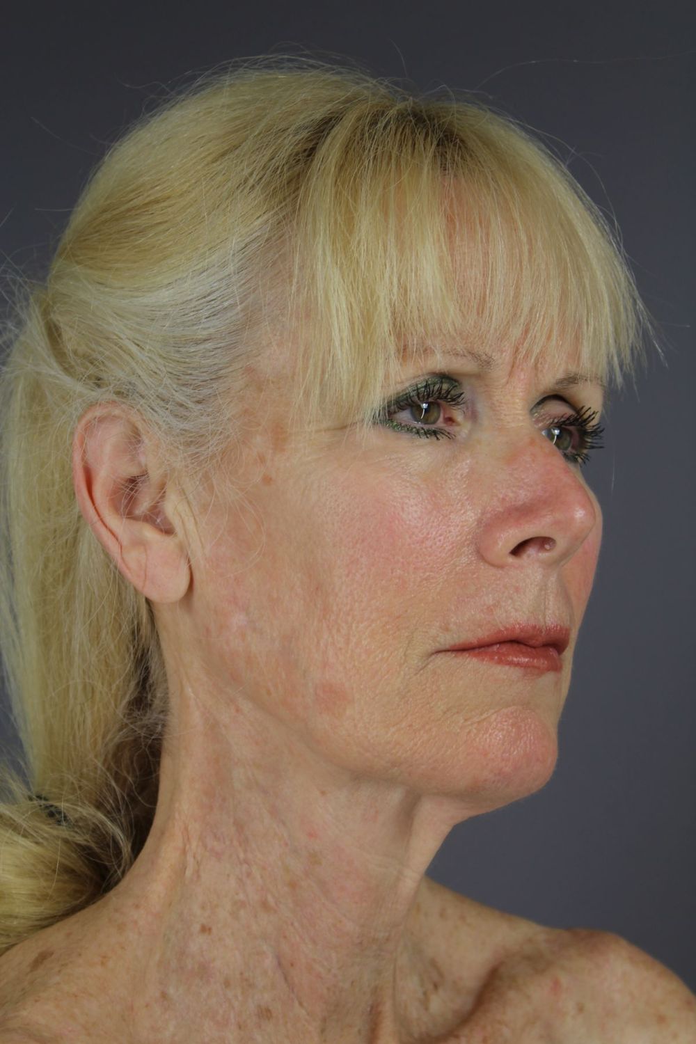 Facial Peels Before & After