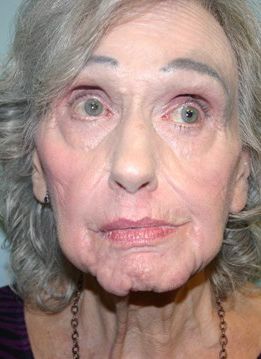 Facial Peels Before & After