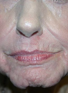 Facial Peels Before & After