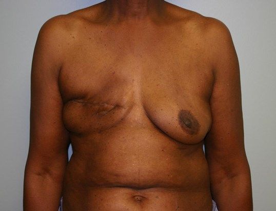 Breast Reconstruction Before & After