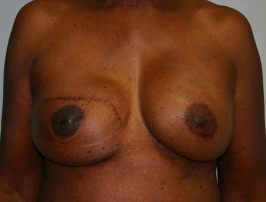 Breast Reconstruction Before & After