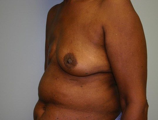 Breast Reconstruction Before & After