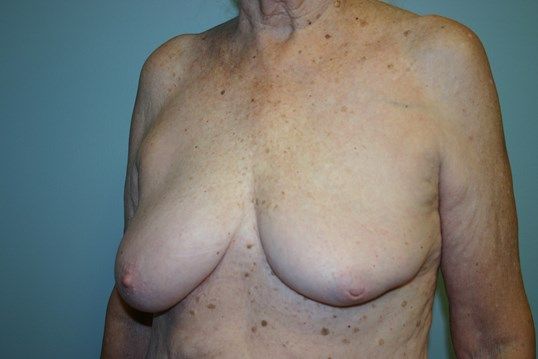 Breast Reconstruction Before & After
