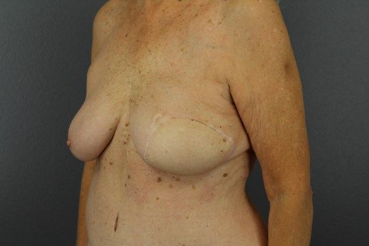 Breast Reconstruction Before & After