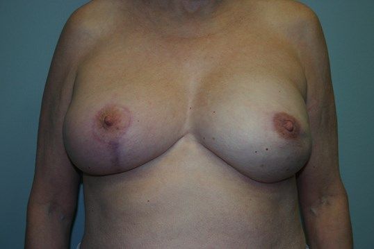 Breast Reconstruction Before & After