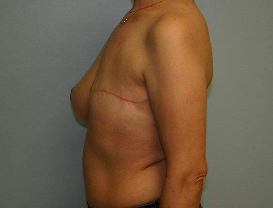 Breast Reconstruction Before & After