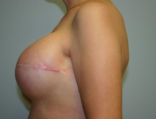 Breast Reconstruction Before & After