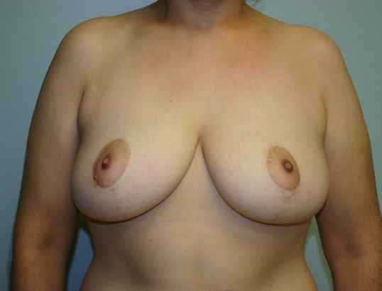 Breast Reduction Before & After