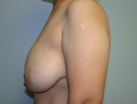 Breast Reduction Before & After