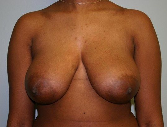 Breast Reduction Before & After