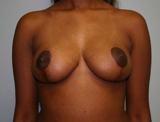 Breast Reduction Before & After