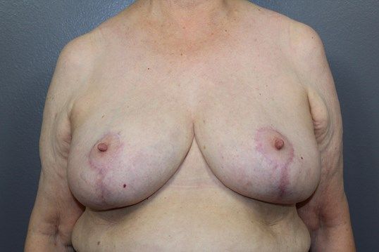 Breast Reduction Before & After