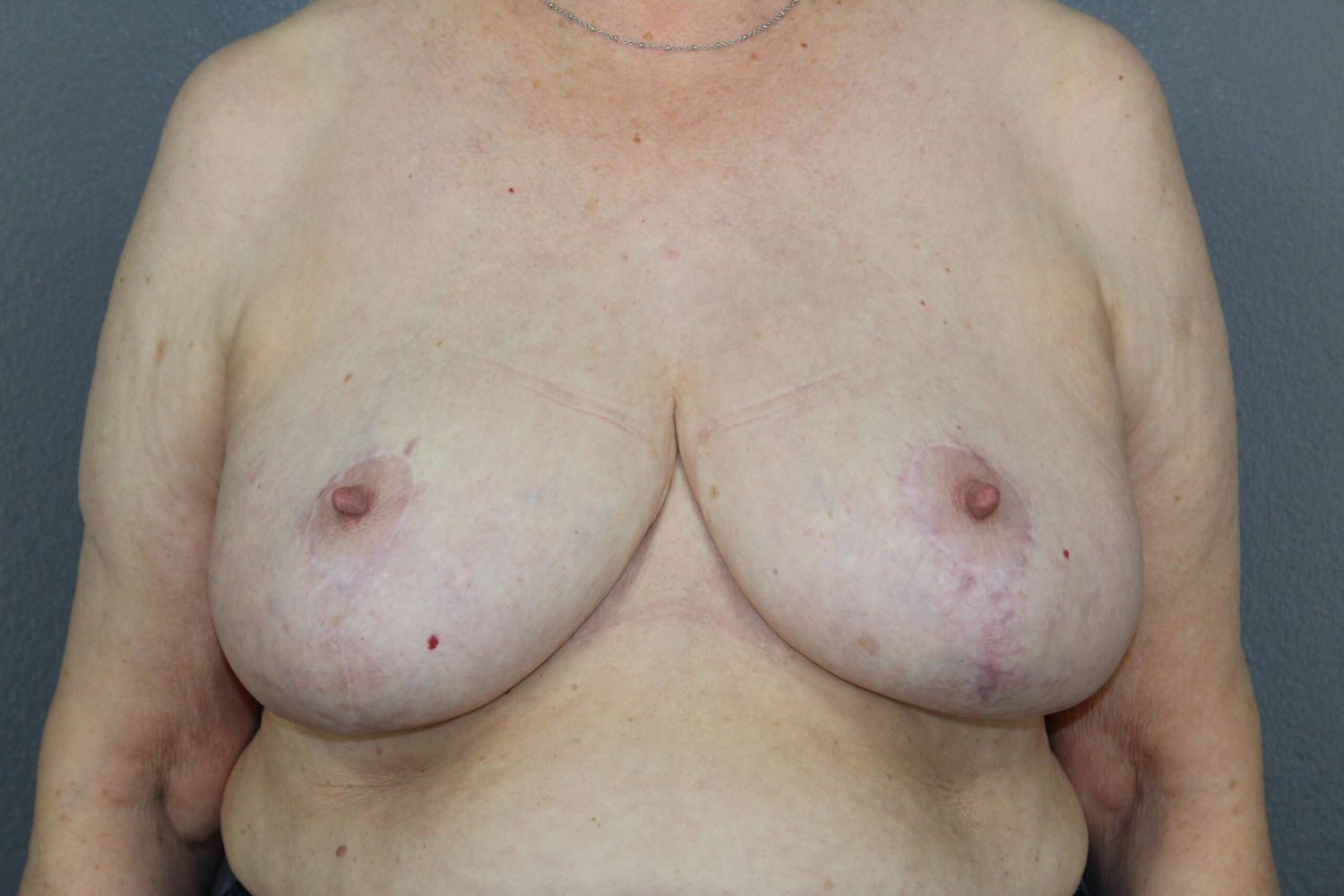 Breast Reduction Before & After