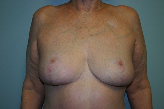 Breast Reduction Before & After