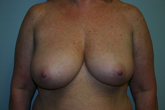 Breast Reduction Before & After